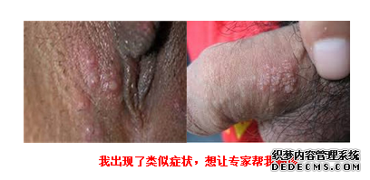 男性生殖器疱疹用药可以吗